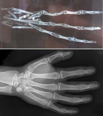 X-ray-of-the-3-fingered-hand.jpg